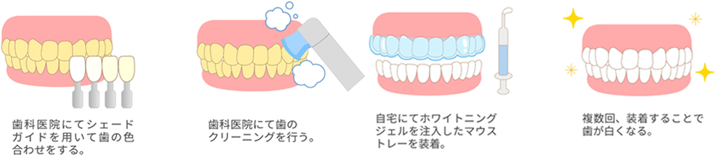 自宅で行う歯のホワイトニングの流れを示したイラスト。1枚目は歯科医院でシェードガイドを使用して歯の色を確認する様子。2枚目は歯のクリーニングを行う様子。3枚目は自宅でホワイトニングジェルを注入したマウストレーを装着する様子。4枚目は複数回の装着により歯が白くなった様子を示している。